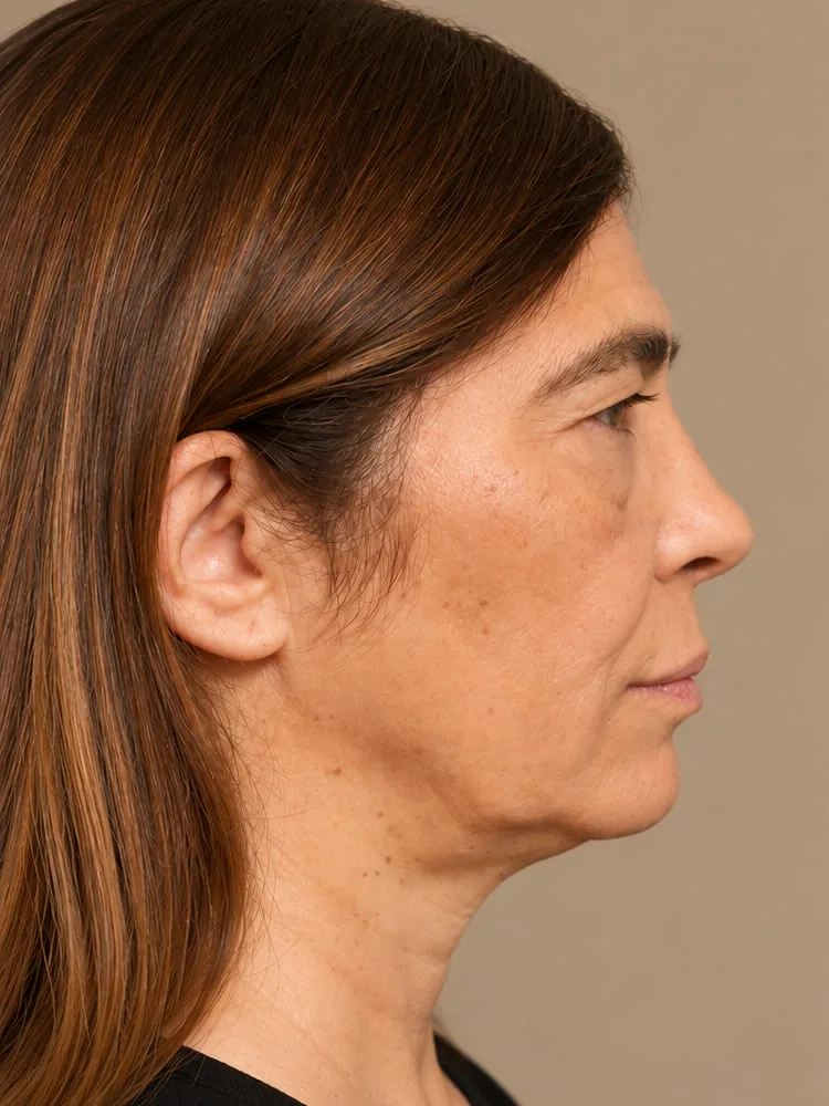 Antes de una cirugía de minilifting facial - caso 4.1