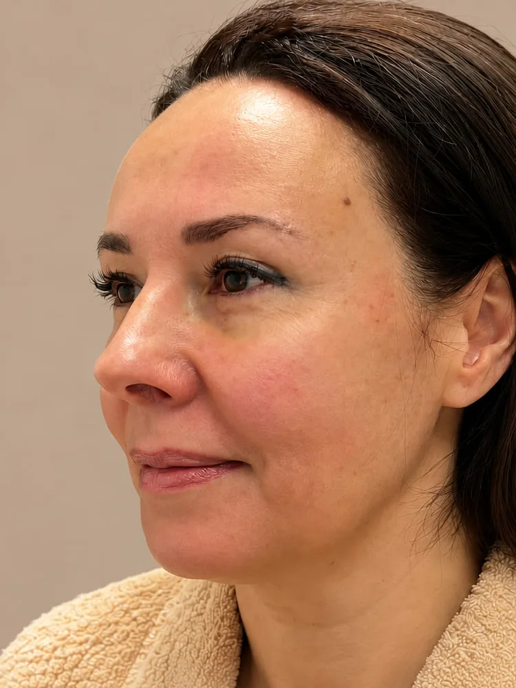 Antes de un tratamiento con Nanofat para rejuvenecimiento facial - caso 2.1
