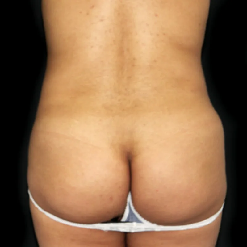 Antes de una cirugía de lipotransferencia - caso 1