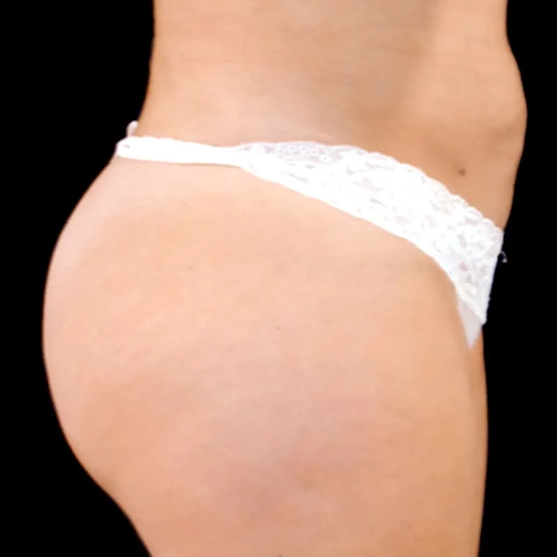 Antes de una cirugía de lipotransferencia - caso 2