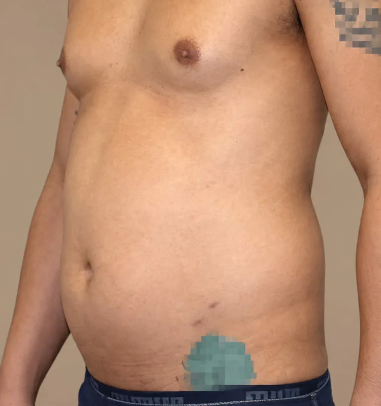 Antes de una cirugía de marcacion abdominal - caso 1.1