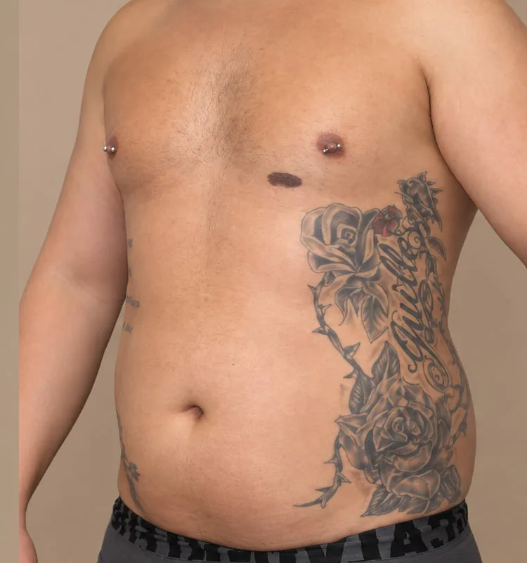 Antes de una cirugía de marcacion abdominal - caso 3.1