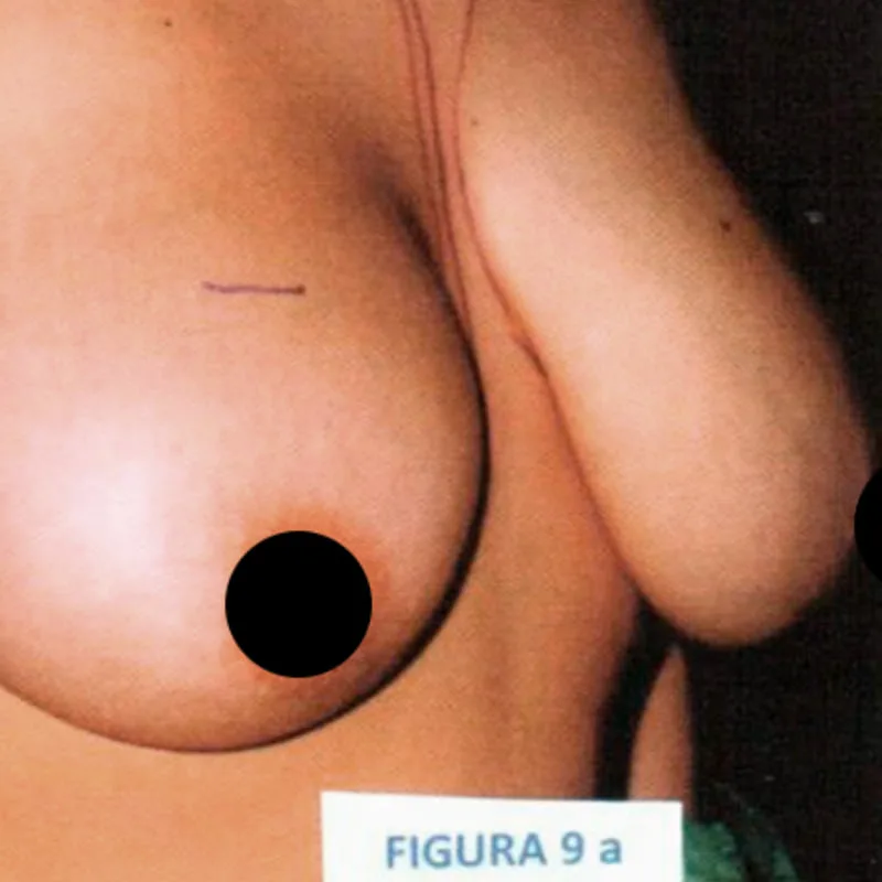 Antes de una cirugía de mastopexia sin cicatrices - caso 3