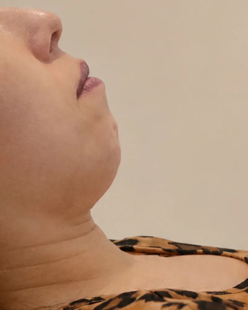 Antes de una cirugía facial de mentoplastia - caso 1