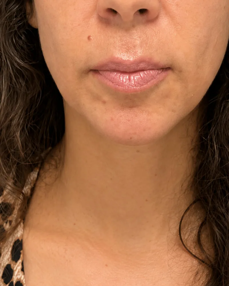 Antes de una cirugía facial de mentoplastia - caso 3