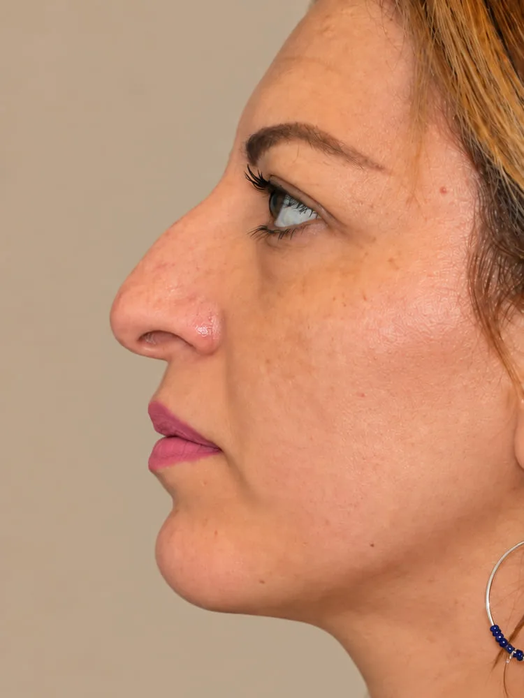 Antes de una cirugía de rinoplastia - caso 2.1