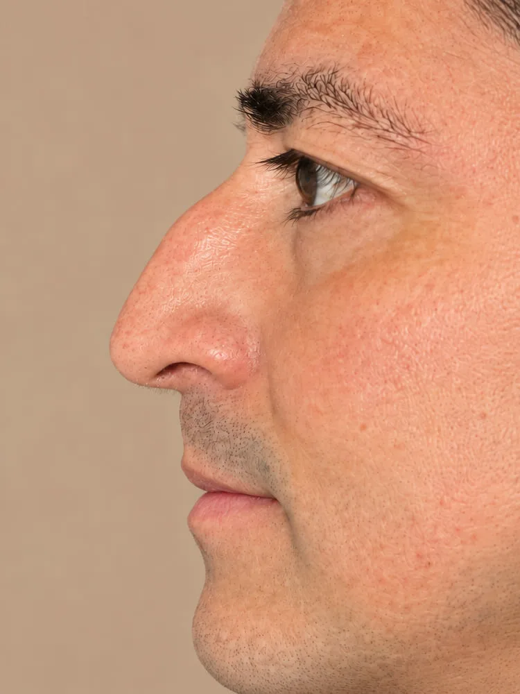 Antes de una cirugía de rinoplastia - caso 3.1