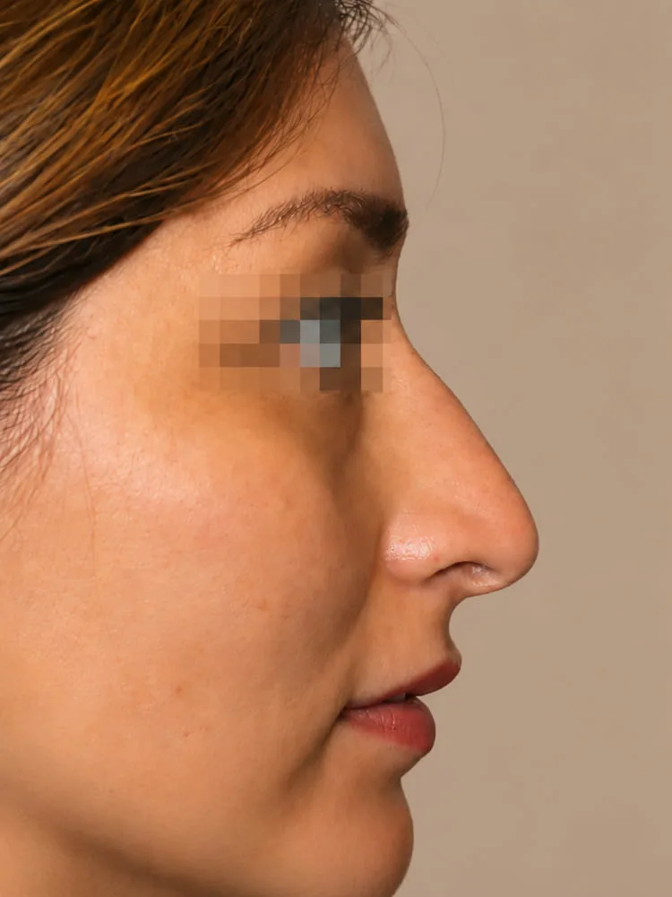 Antes de una cirugía de rinoplastia - caso 4.1