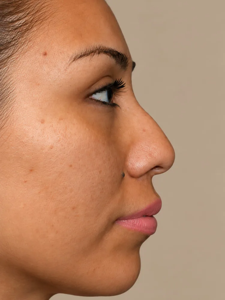 Antes de una cirugía de rinoplastia - caso 6.1