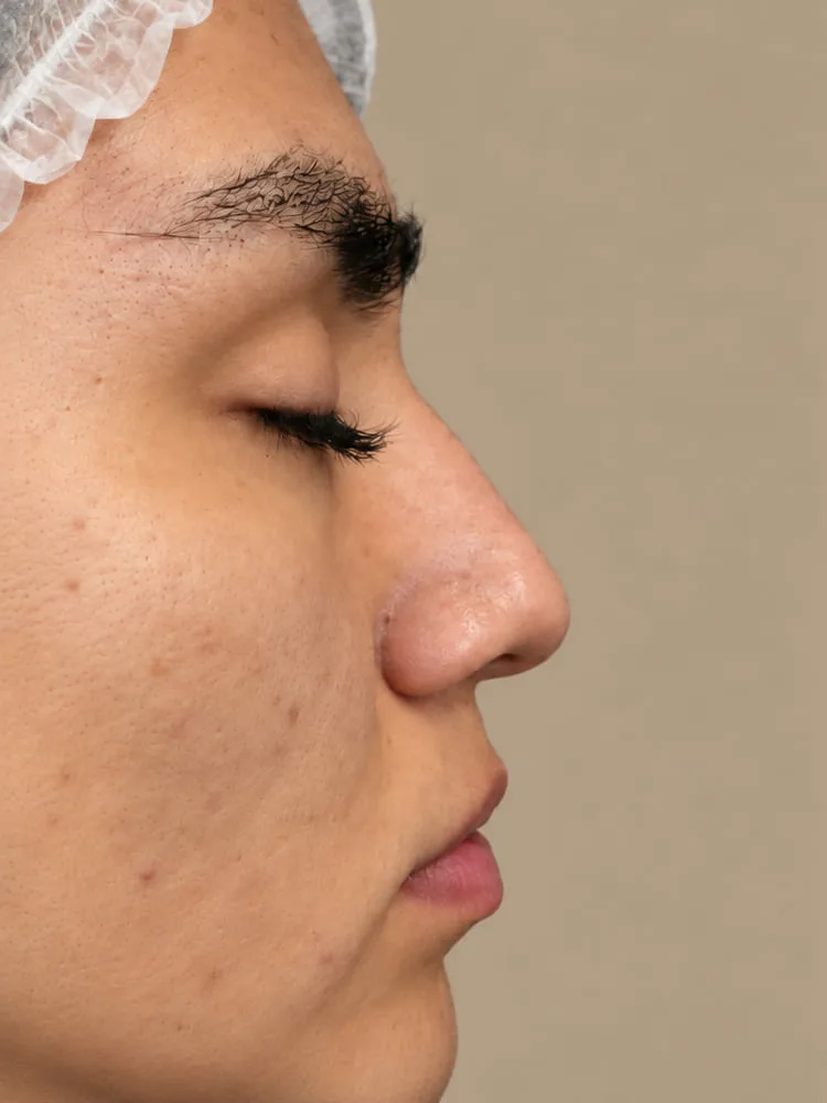 Antes de una cirugía de rinoplastia - caso 7.1