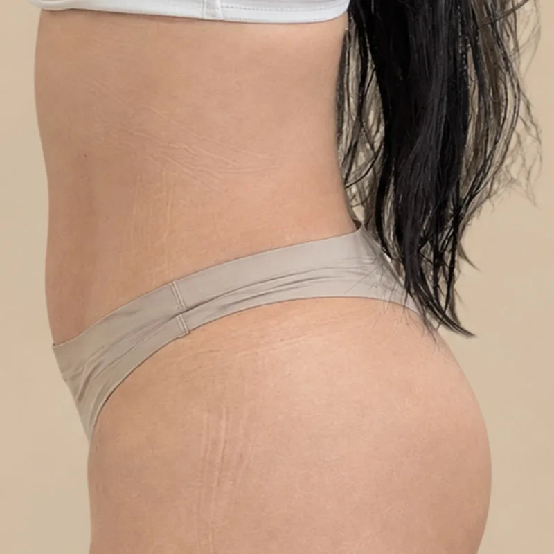 despues-de-una cirugía de Lipo-Vaser-caso5