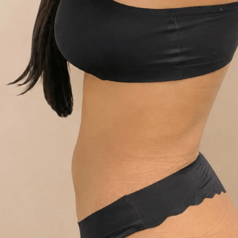 despues-de-una cirugía de Lipo-Vaser-caso7