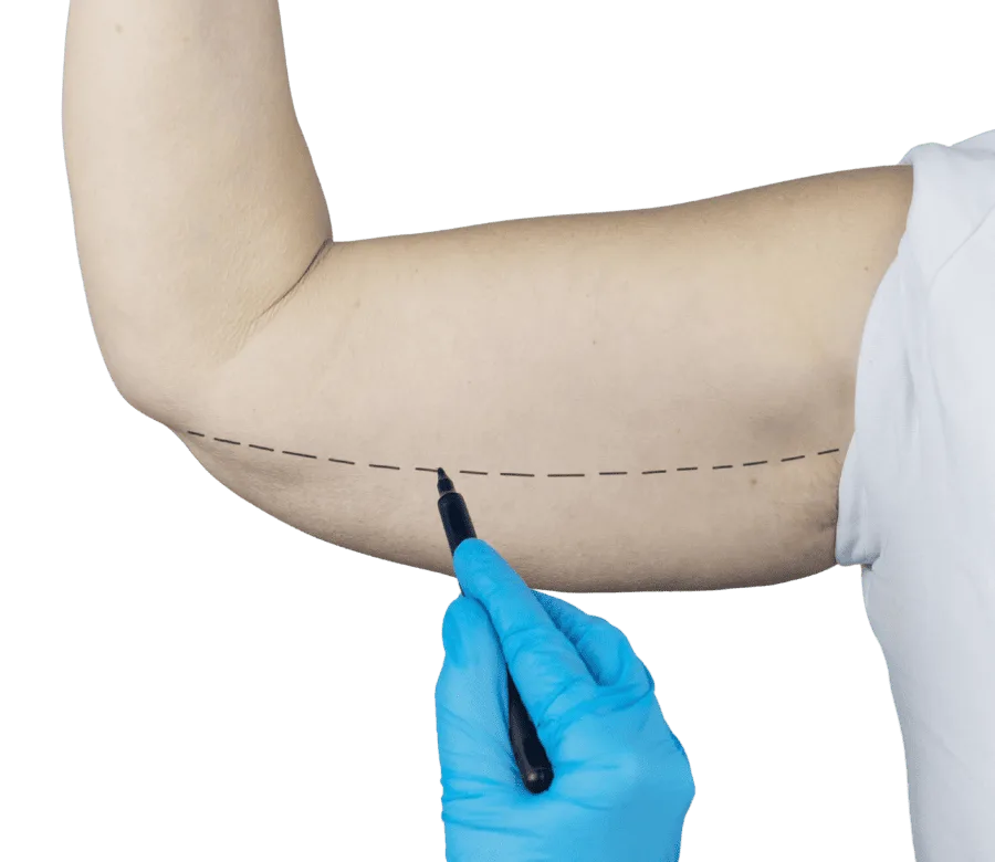 Braquioplastia para reducir el descolgamiento y mejorar el contorno de los brazos