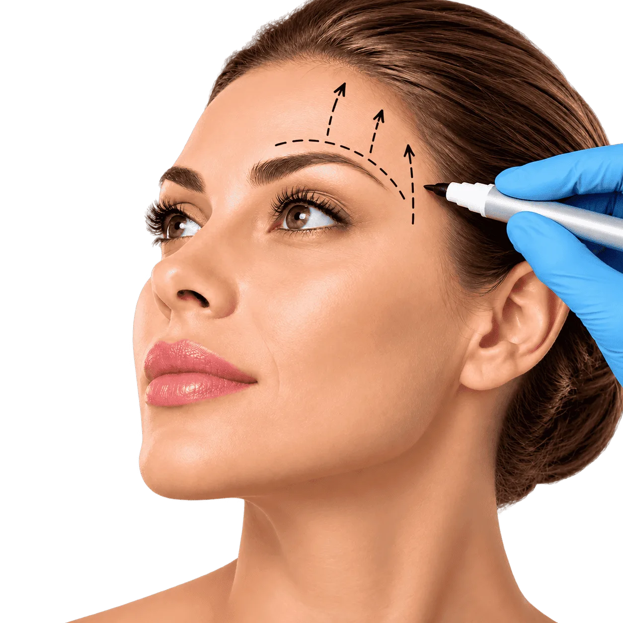 Marcación previa para cirugía de lifting de cejas