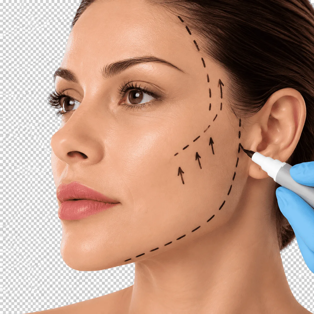 Marcación facial previa a una cirugía de minilifting facial