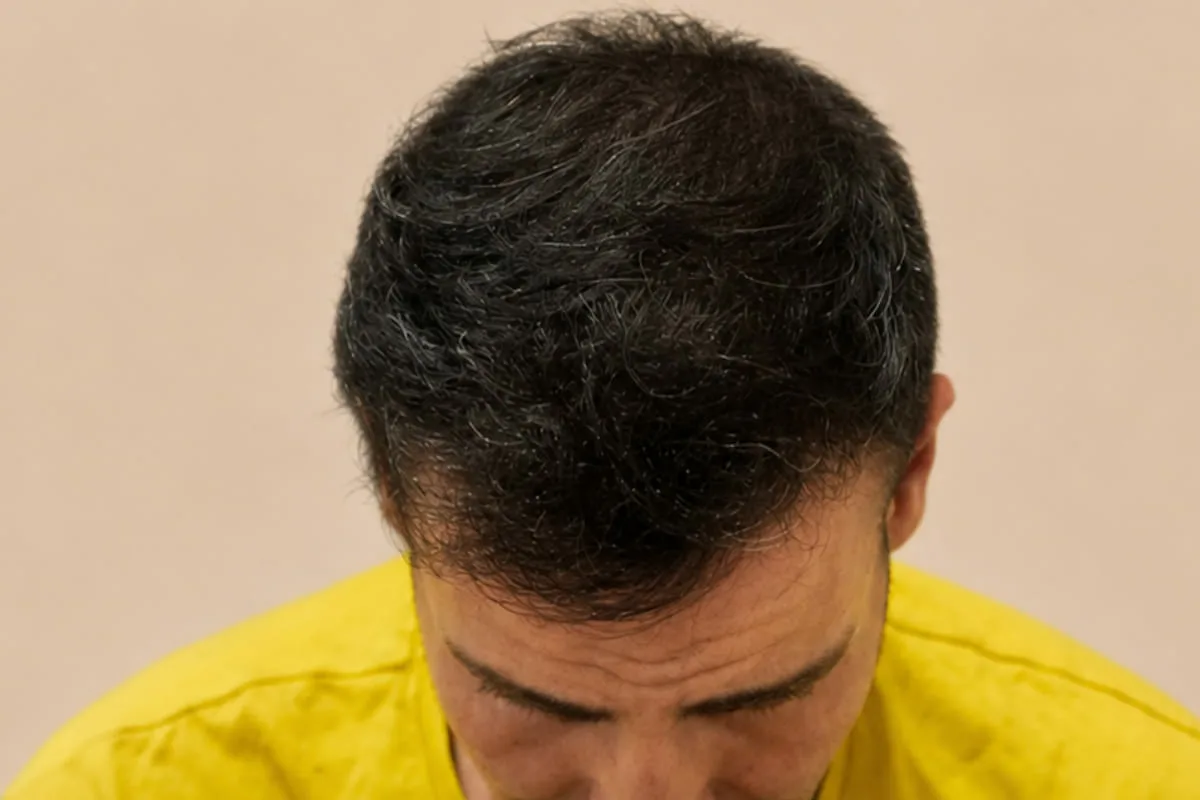 Después de una cirugía de injerto capilar - caso 1