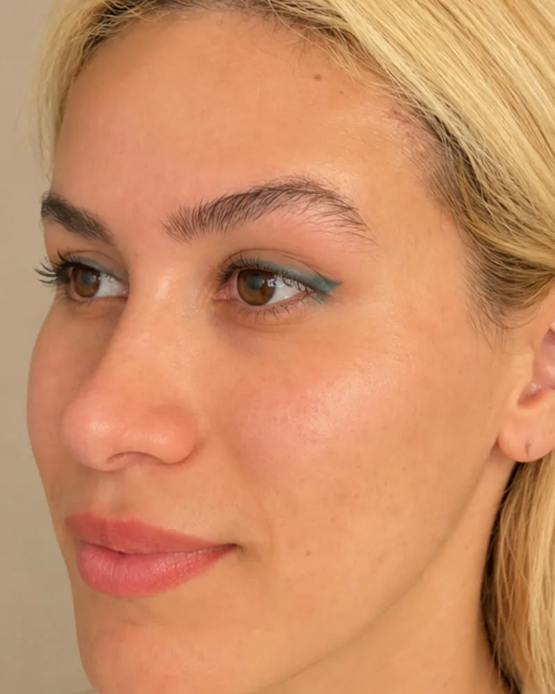 Después de una cirugía de lifting de cejas - caso 1