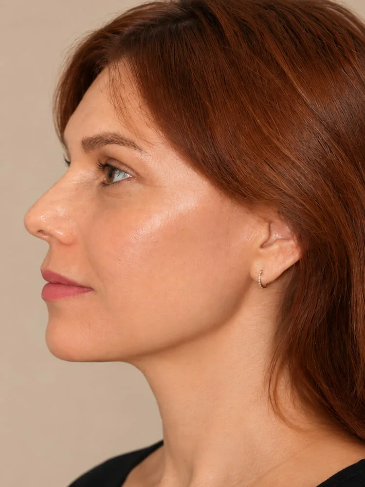 Después de una cirugía de minilifting facial - caso 4.1