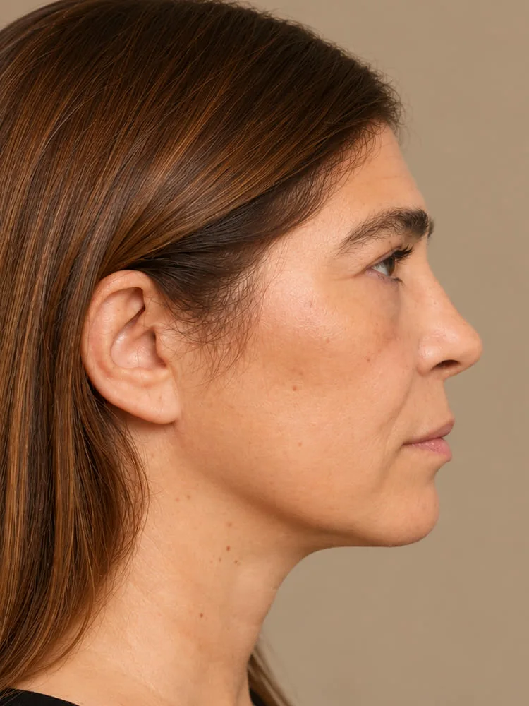 Después de una cirugía de minilifting facial - caso 4.1