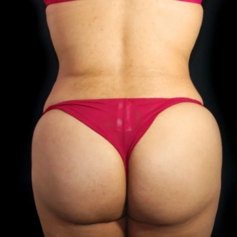 Despues de una lipotransferencia - caso 1