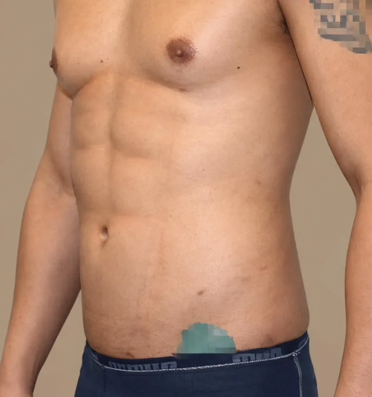 Resultado después de una marcacion abdominal - caso 1.1