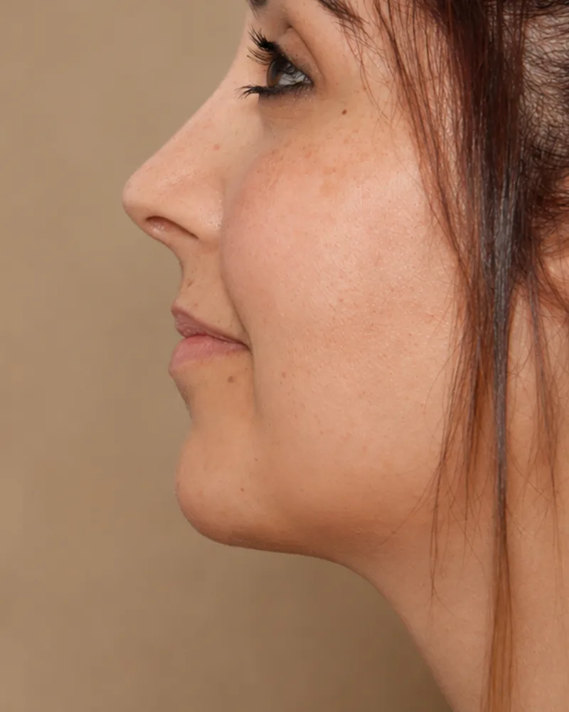 Resultado después de una cirugía facial de mentoplastia- caso 2