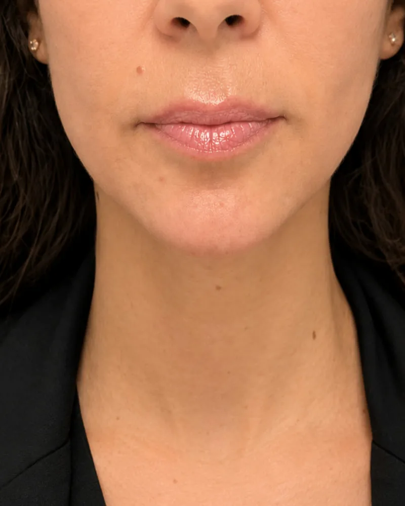 Resultado después de una cirugía facial de mentoplastia- caso 3
