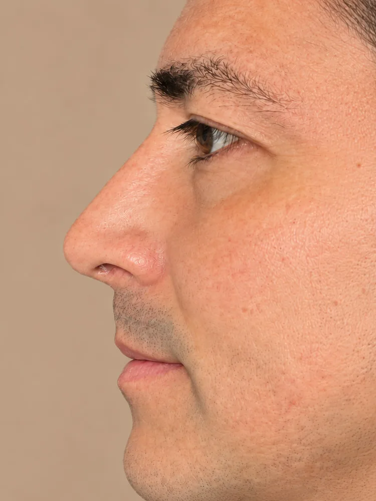 Resultado después de una cirugía de rinoplastia - caso 3.1
