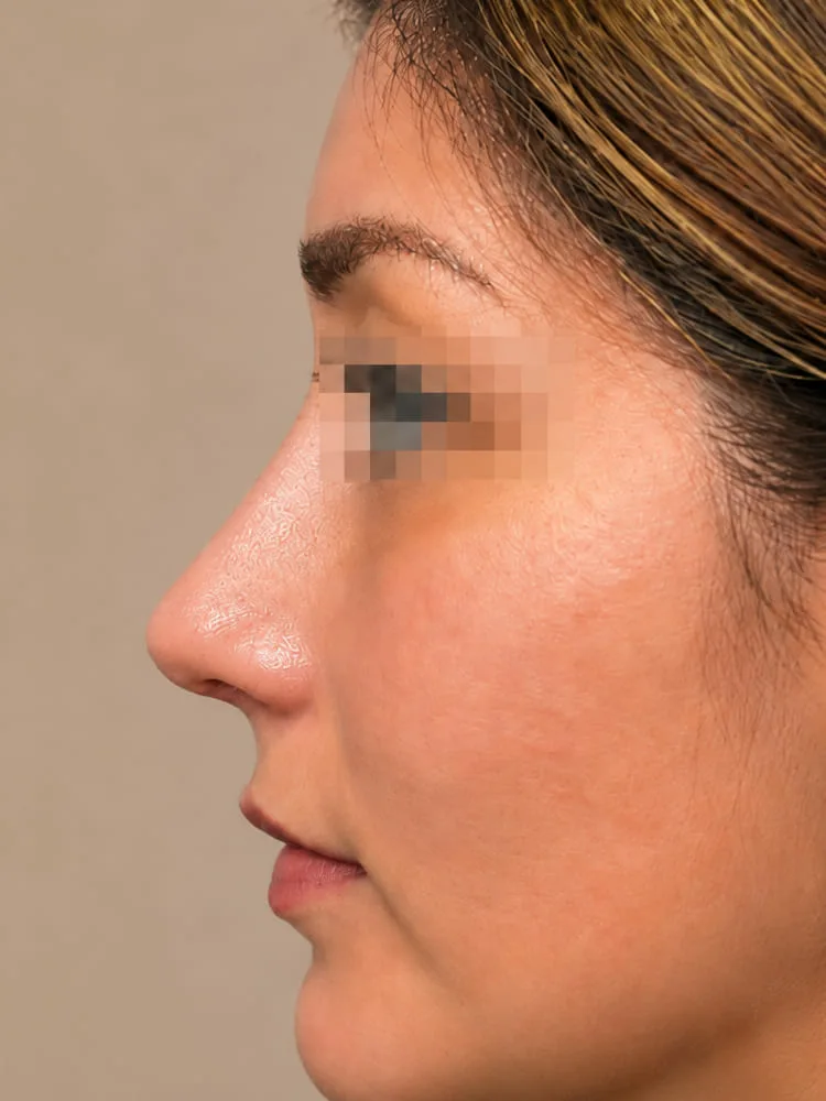 Resultado después de una cirugía de rinoplastia - caso 4.1