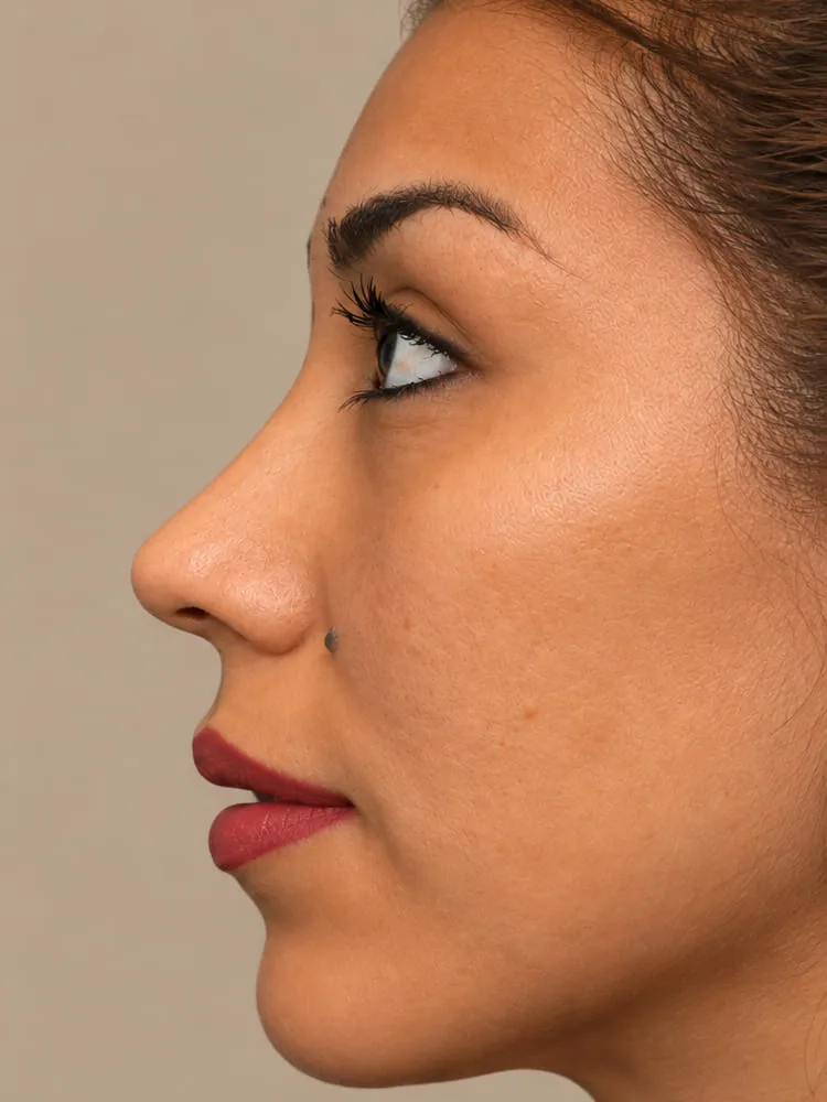 Resultado después de una cirugía de rinoplastia - caso 6.1