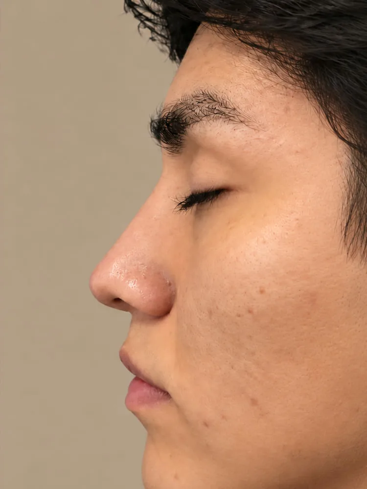 Resultado después de una cirugía de rinoplastia - caso 7.1