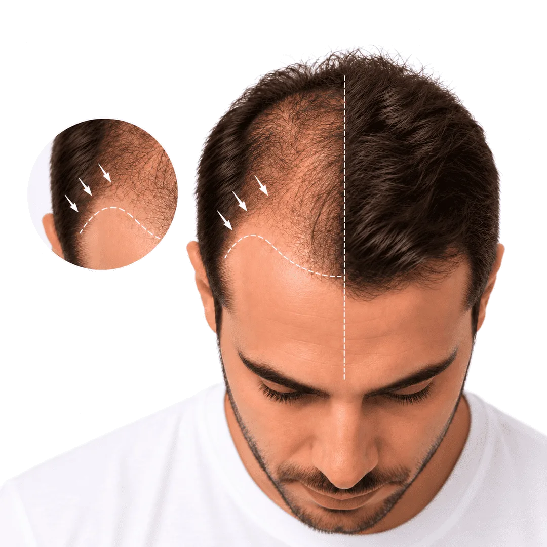Injerto capilar FUE para recuperar cabello en zonas con pérdida de densidad