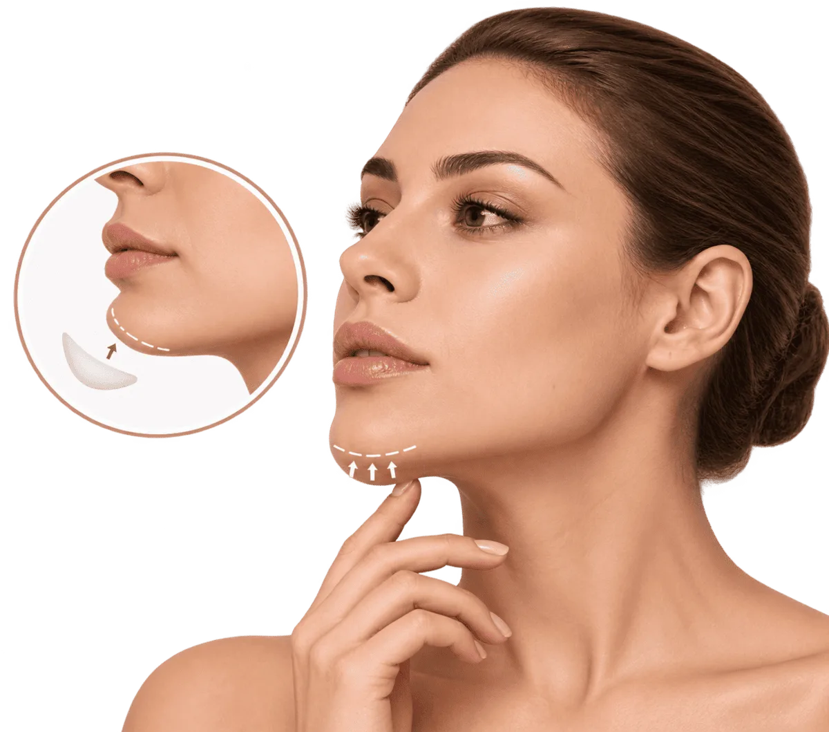 Mentoplastia para armonizar el mentón y mejorar el equilibrio del perfil facial