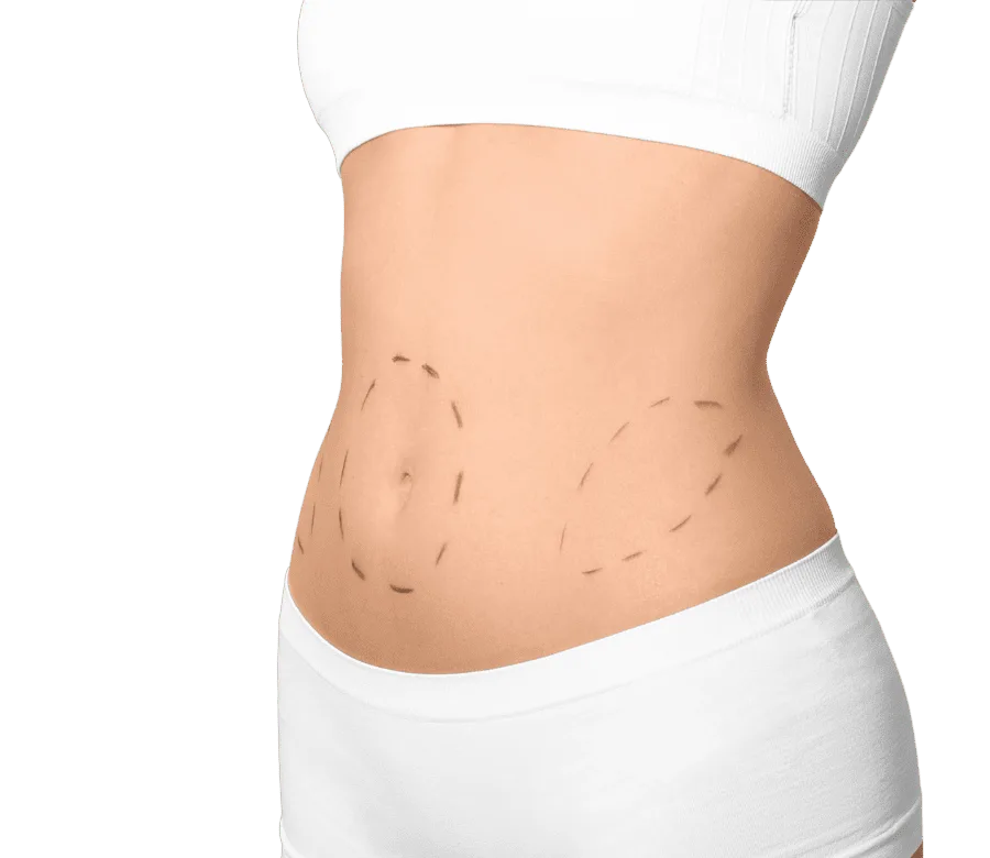 Cirugía de miniabdominoplastia para tensar y mejorar el contorno del abdomen inferior