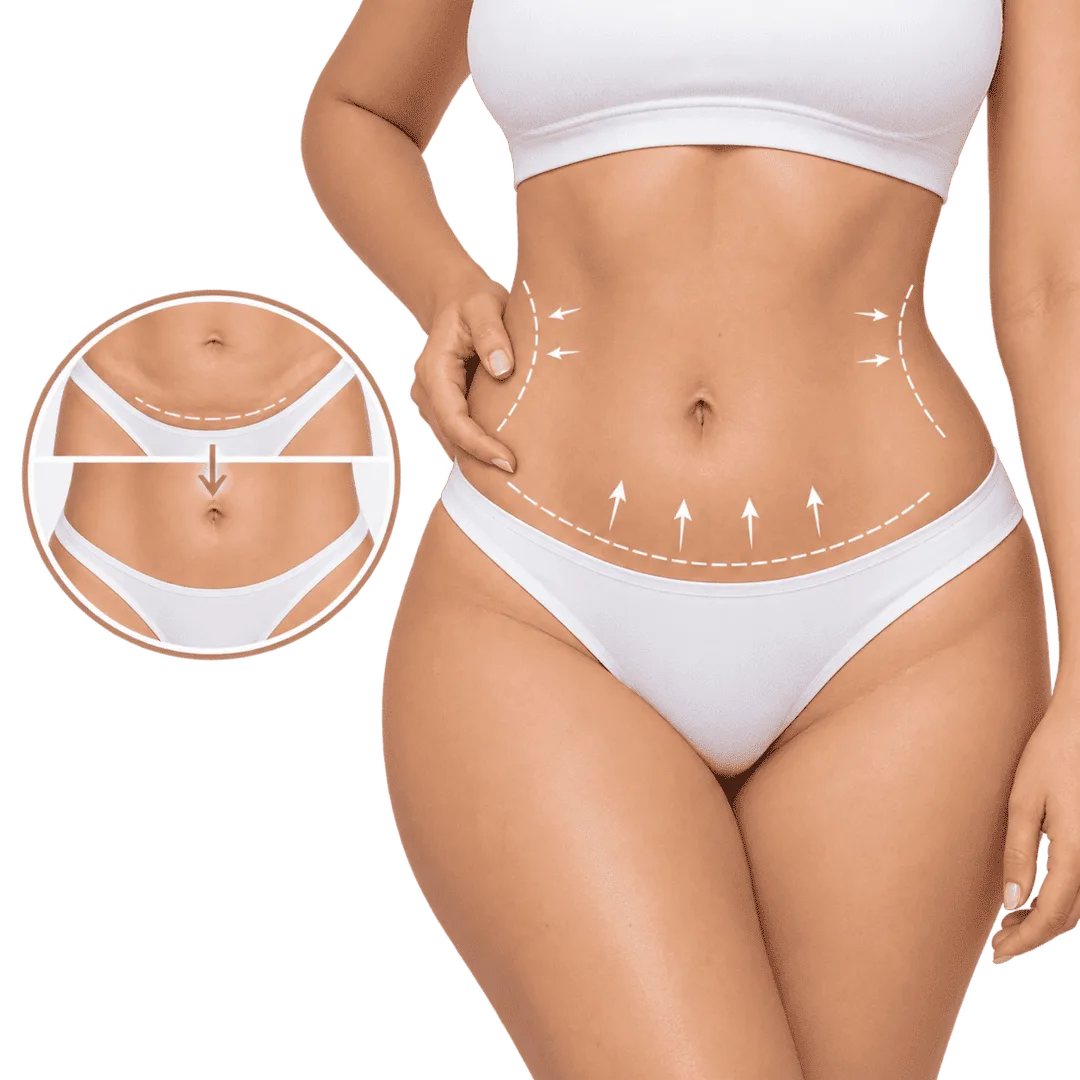 Miniabdominoplastia para remodelar y tensar la zona inferior del abdomen bajo el ombligo